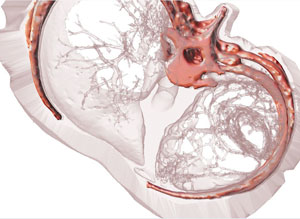 3D imagery of COPD lungs